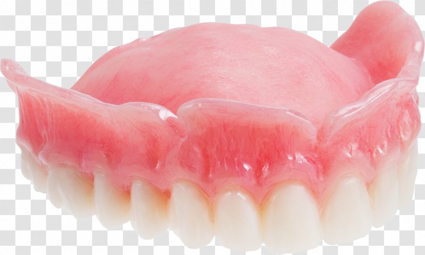 Dentures Dentistry Maxilla Tooth Dental Implant - Jaw - Upper Transparent PNG