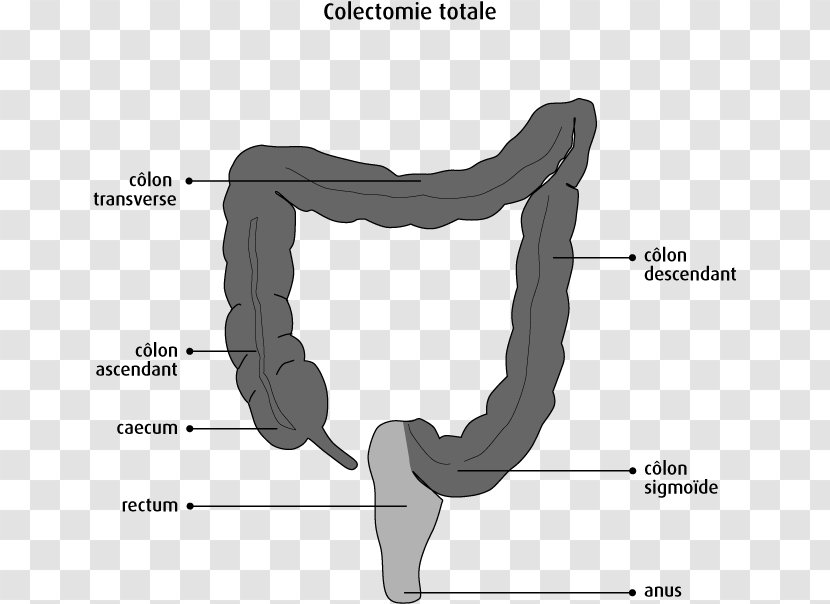 Colectomy Bowel Resection Lower Anterior Surgery Ileo-anal Pouch - Heart - Diagnosis And Treatment Transparent PNG
