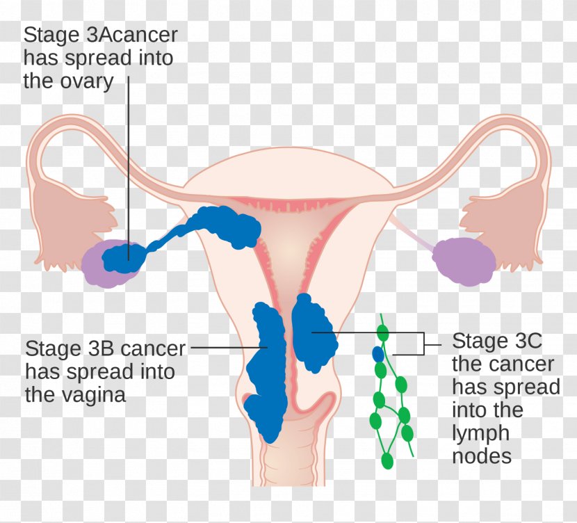 Uterine Cancer Endometrial Endometrium Staging - Flower - Nettle Transparent PNG
