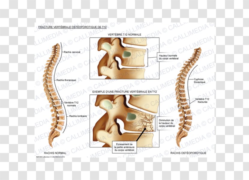 Vertebral Column Bone Fracture Compression Spinal - Silhouette Transparent PNG