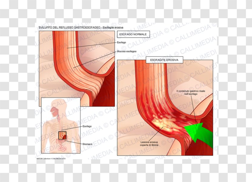 Gastroesophageal Reflux Disease Esophagus Esophagitis Cough - Tree - Flower Transparent PNG