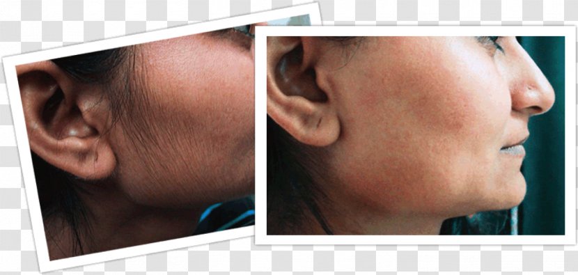 Hair Removal Facial Woman Human Growth - Jaw - Laser Transparent PNG