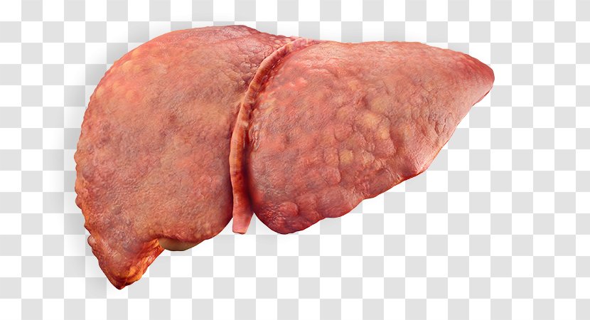 Alcoholic Liver Disease Cirrhosis Fatty - Watercolor - Image Transparent PNG