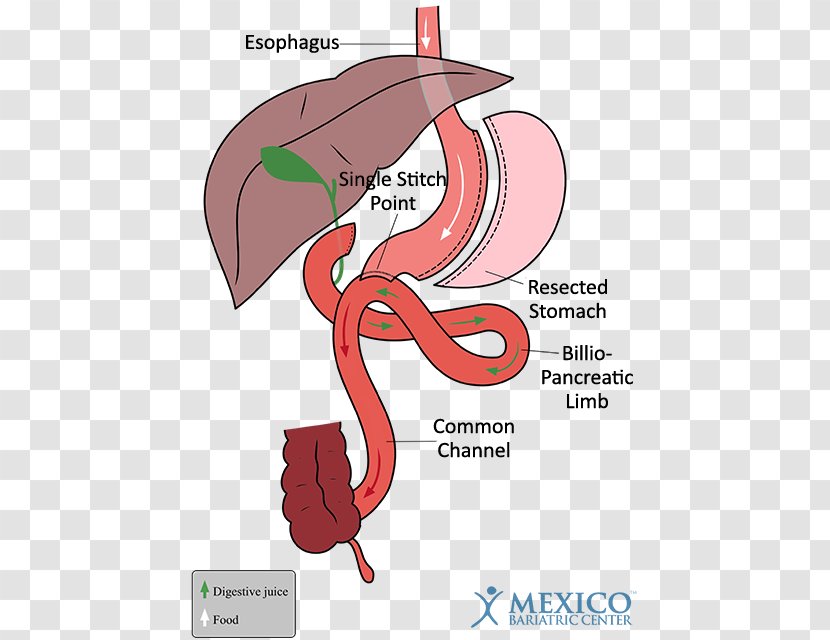 Duodenal Switch Gastric Bypass Surgery Sleeve Gastrectomy Bariatric - Frame - Silhouette Transparent PNG