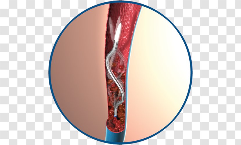 Inferior Vena Cava Filter Interventional Radiology Vascular Surgery Blood Vessel - Argon - Vein Transparent PNG