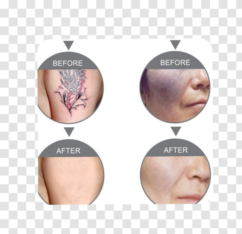 Nd:YAG Laser Tattoo Removal Photorejuvenation Hair - Radio Frequency Skin Tightening - Shoulder Transparent PNG