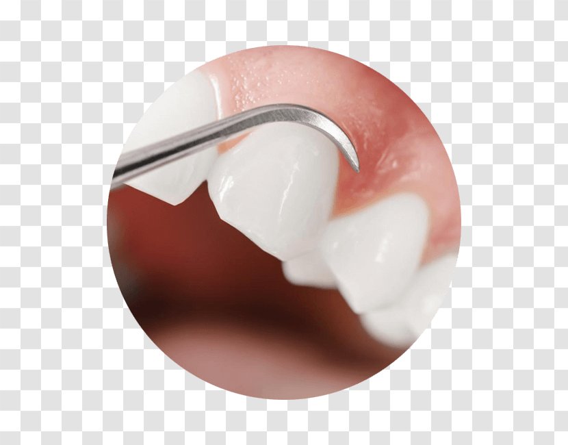 Gums Periodontal Disease Gingivitis Gingival Recession Dental Calculus - Eyelash - Therapy Transparent PNG