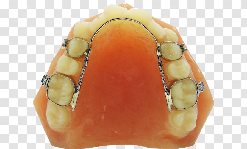 ROA - Dental Braces - Ricoh Orthodontic Appliances Orthodontics Home Appliance Technology DentistryOthers Transparent PNG