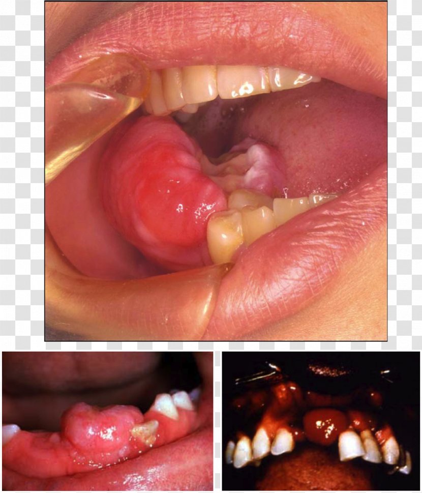Odontogenic Cyst Peripheral Fibroma Ossifying - Dermitek Transparent PNG