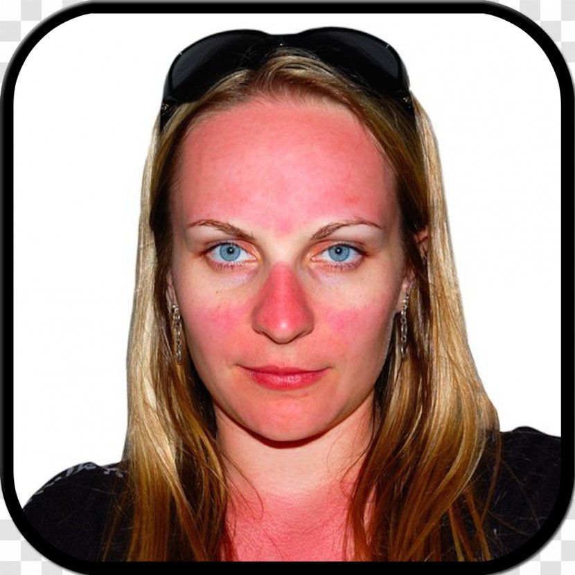 Sunburn Skin Face - Health - Burn Transparent PNG