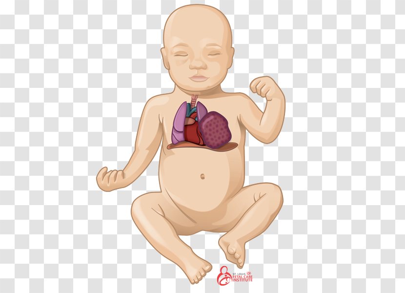 Pulmonary Hypoplasia Lung Congenital Airway Malformation Sequestration - Silhouette - Pregnancy Transparent PNG