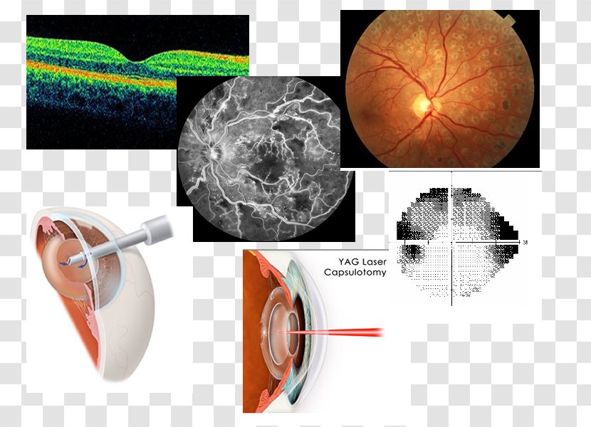 Plastic Cataract Surgery - Design Transparent PNG