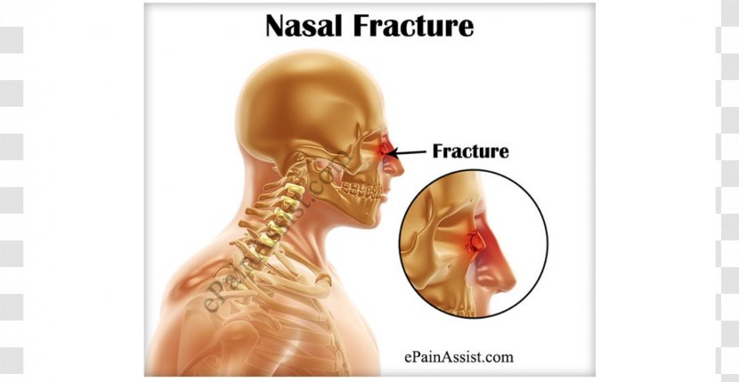 Nasal Fracture Nose Bone Surgery - Heart - Headache Transparent PNG