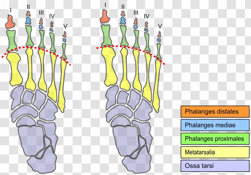 Morton's Toe Neuroma Foot Metatarsal Bones - Disease - Organism Transparent PNG