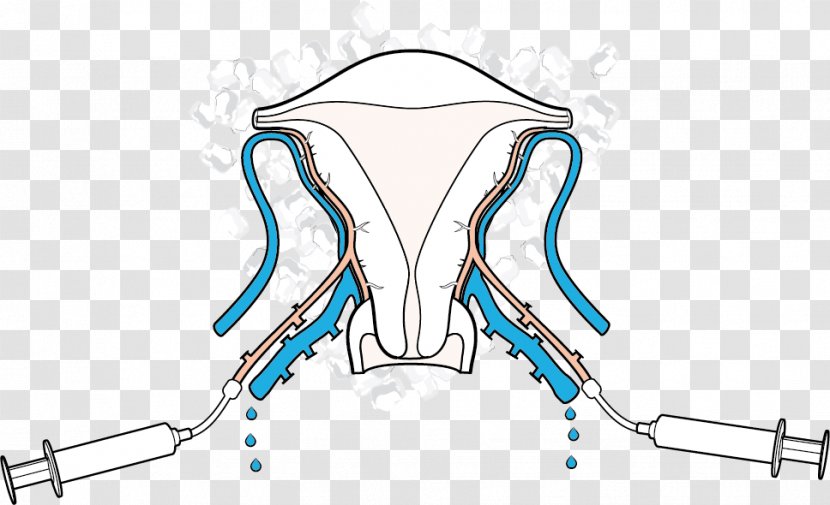 Uterus Transplantation Female Infertility In Vitro Fertilisation - Cartoon - Watercolor Transparent PNG