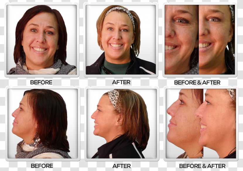 Light Therapy Skin Face Ultrasound Forehead - Rhytidectomy - Before And After Transparent PNG