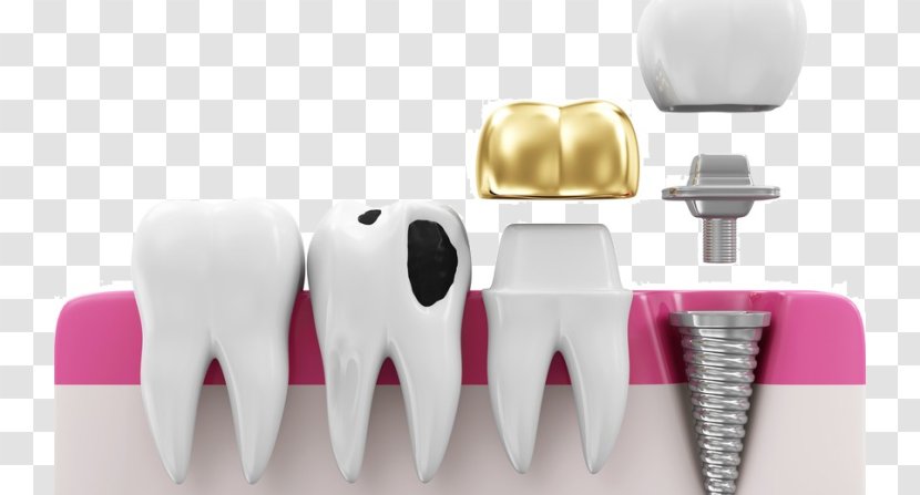 Crown Dentistry Dental Implant Bridge - Silhouette Transparent PNG