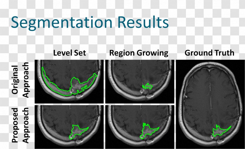 Image Segmentation Brain Tumor Magnetic Resonance Imaging Analysis Region Growing - Medical Transparent PNG