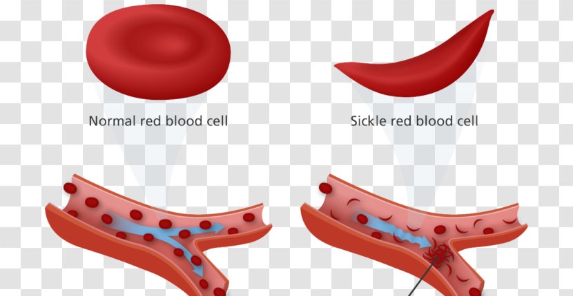 Sickle Cell Disease Anemia Trait Red Blood - World Health Day Transparent PNG