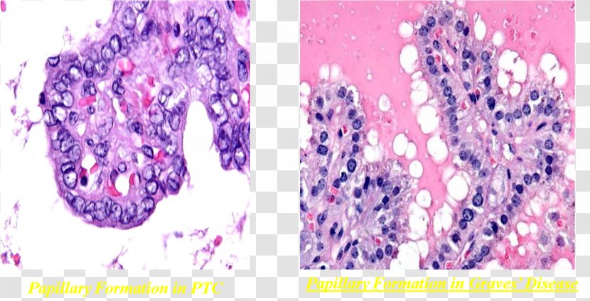 Thyroid Cancer Benign Tumor Goitre - Follicular Transparent PNG
