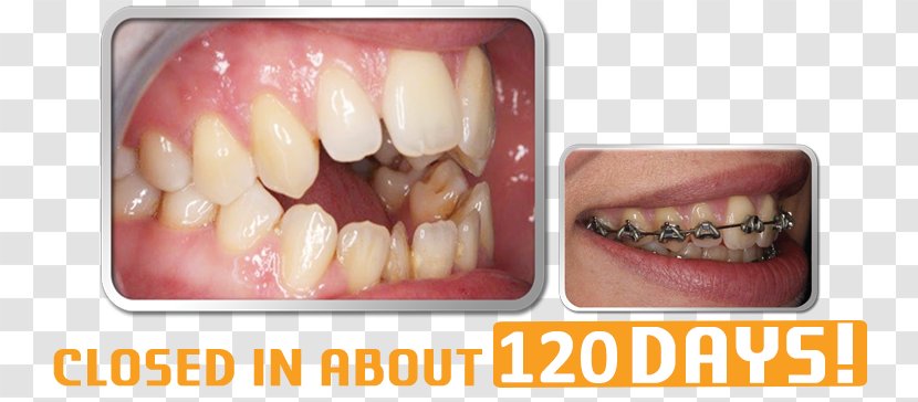 Tooth Orthodontics Dental Braces Dentistry - Dentures Transparent PNG