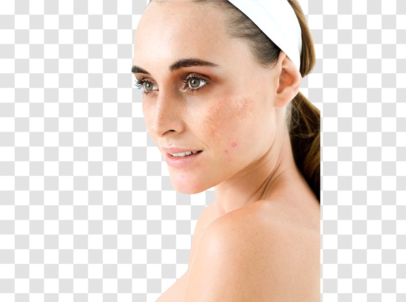 Hyperpigmentation Face Melasma Therapy Human Skin Color - Eyebrow Transparent PNG
