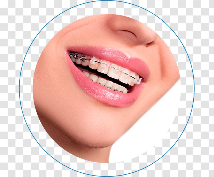 Dental Braces Orthodontics Clear Aligners Dentistry Self-ligating Bracket - Tooth Enamel - Dentistas Fluor Transparent PNG
