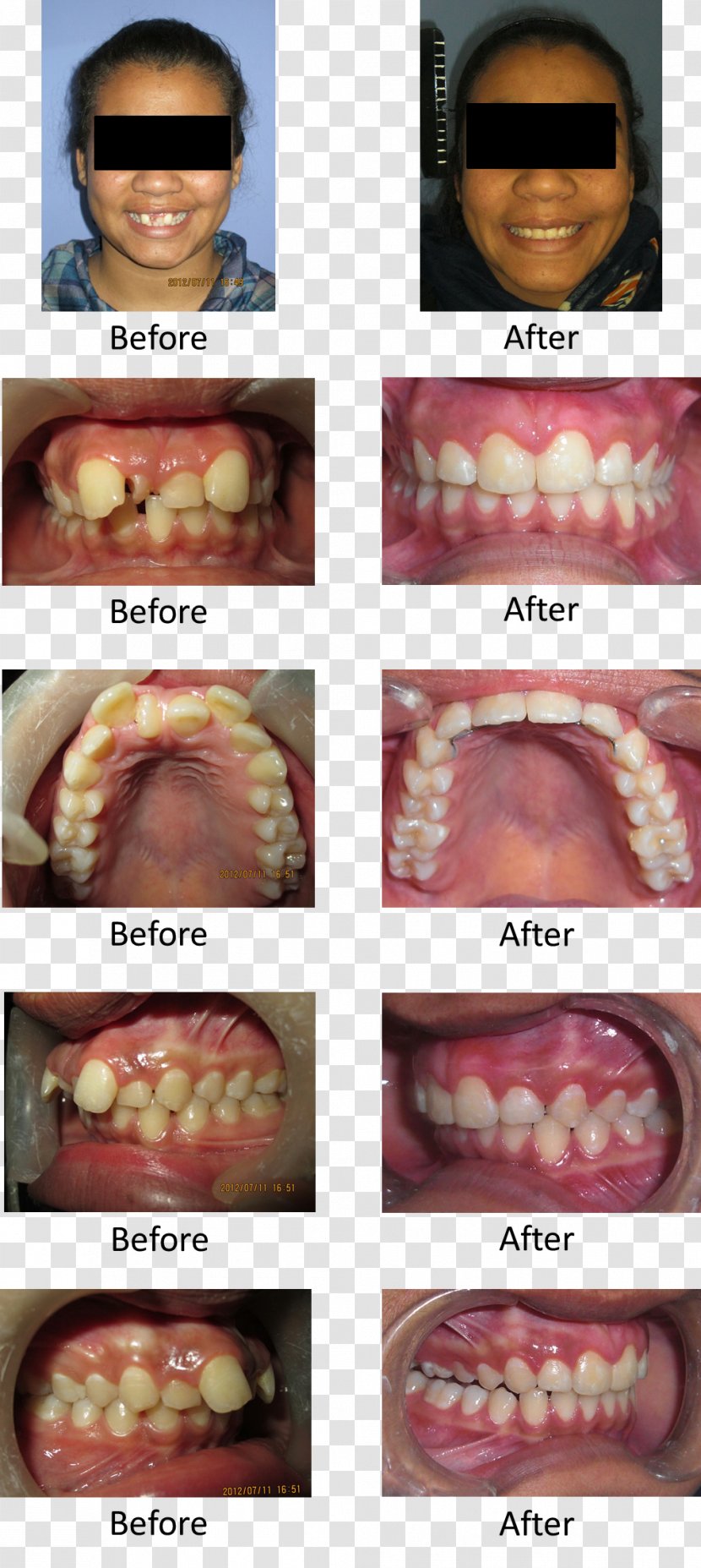 Hyperdontia Human Tooth Molar Disease - Jaw Transparent PNG