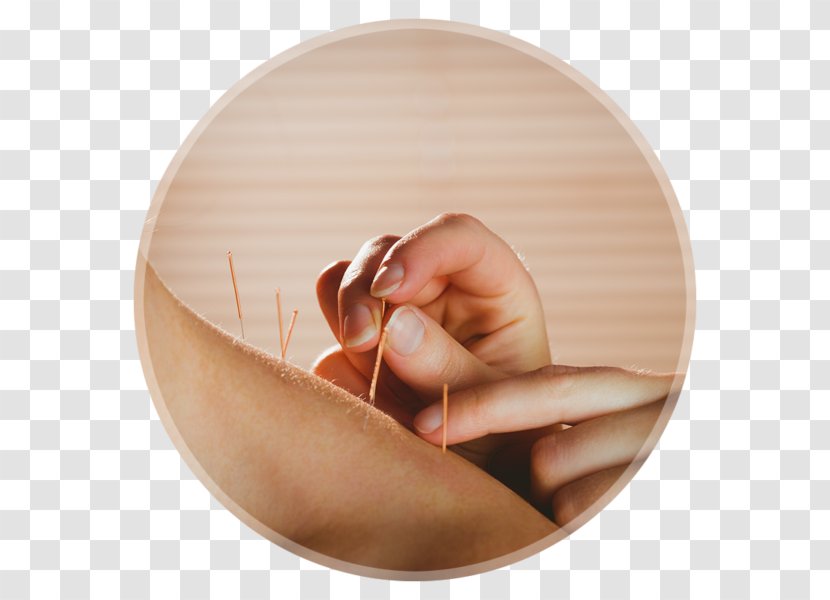 Dry Needling Myofascial Trigger Point Acupuncture Myotherapy Release - Manual Therapy - Sunshine Coast Clinic Wit Transparent PNG