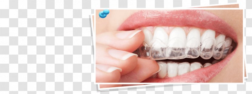 Clear Aligners Dental Braces Cosmetic Dentistry Orthodontics - Finger - Lingual Transparent PNG