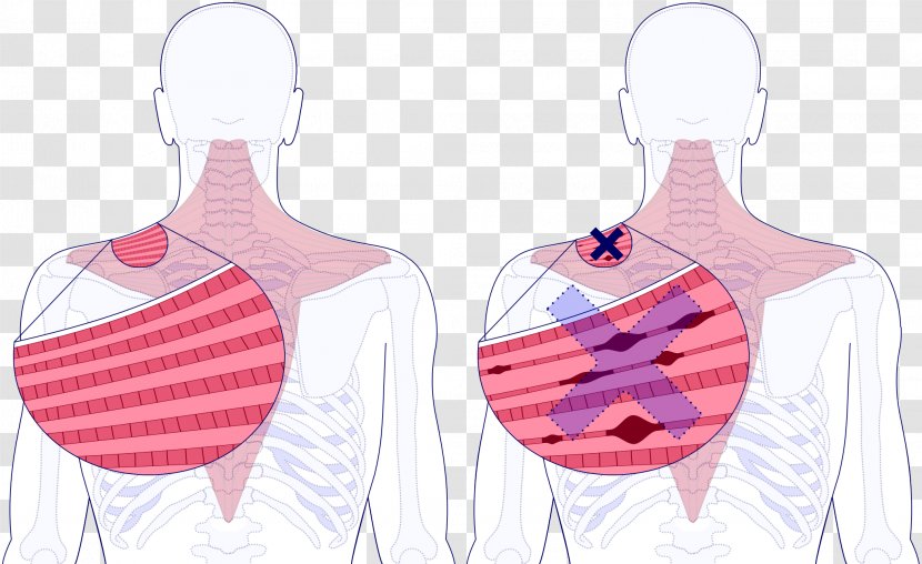 Myofascial Trigger Point Muscle Trikala Nodule Release - Pink Transparent PNG