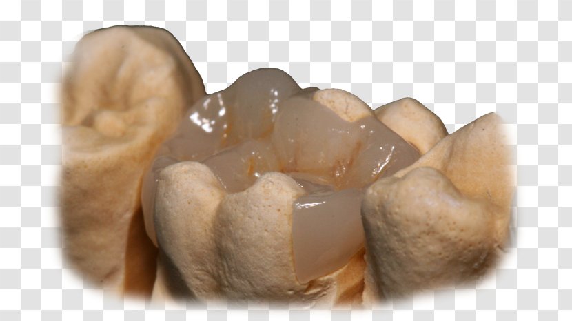 Crown CAD/CAM Dentistry Inlays And Onlays Bridge - Ceramic - Slider Images Transparent PNG