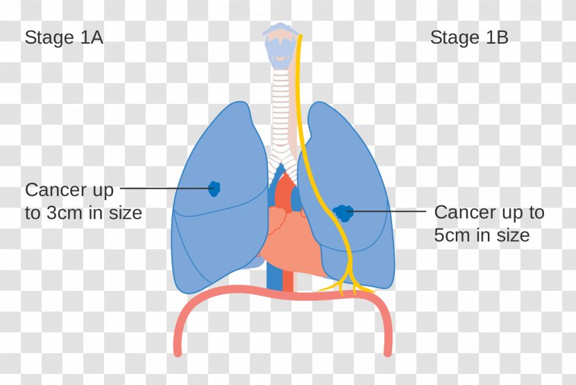 Lung Cancer Staging - Flower Transparent PNG