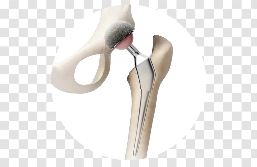 Hip Replacement Prosthesis Knee - Surgery - Artrosis De Rodilla Transparent PNG