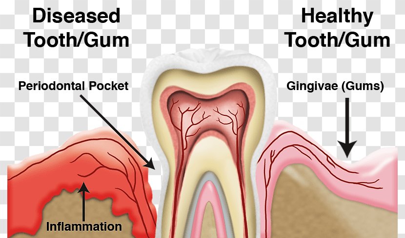 Periodontal Disease Gums Periodontology Dentistry - Frame Transparent PNG