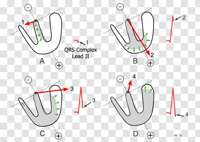 QRS Complex Electrocardiography Heart Depolarization Left Axis Deviation - Epicardium Transparent PNG