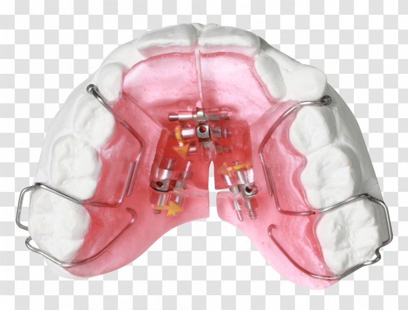 Gergen's Orthodontic Lab Technology Orthodontics Jaw Bionator - Obstructive Sleep Apnea Transparent PNG