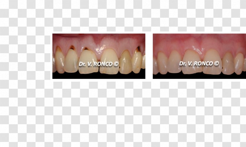 Tooth Dentist Gums Gingival Graft Dental Implant - Tree Transparent PNG