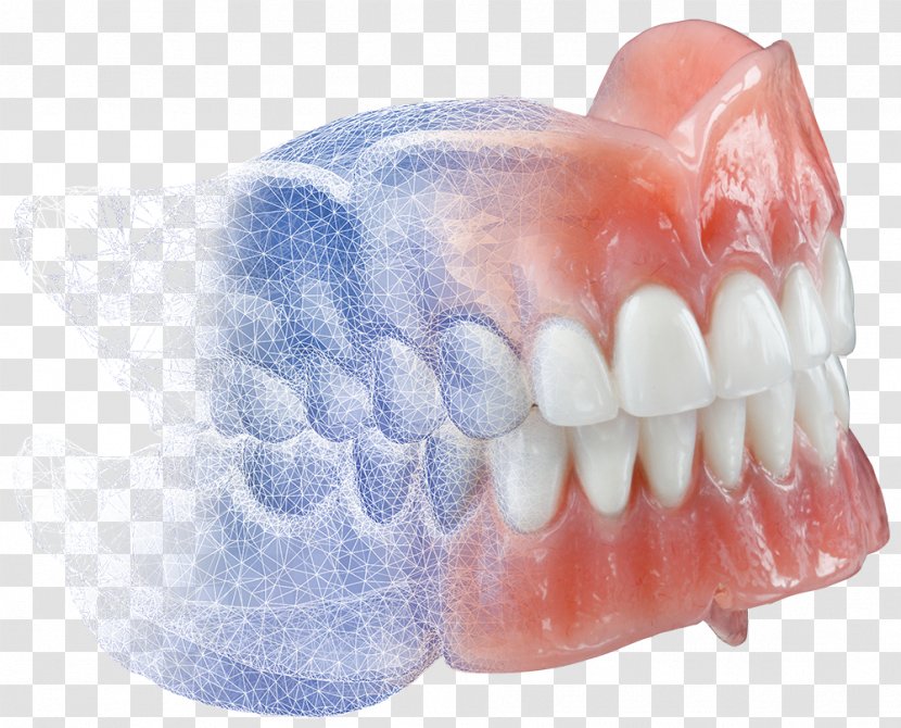Dentures Burdette Dental Lab CAD/CAM Dentistry - Patient - 3d Treatment For Toothache Transparent PNG