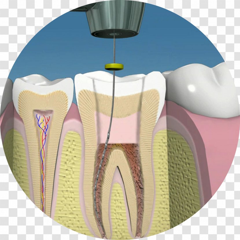 Endodontic Therapy Dentistry Human Tooth Pulp - Cartoon - Endodoncia Transparent PNG