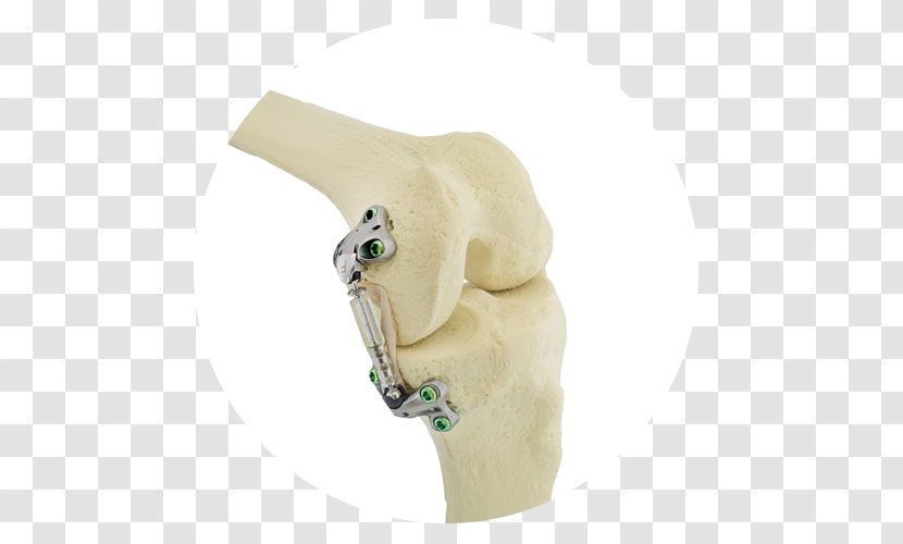 Knee Osteoarthritis Arthritis NASDAQ:SPNE Transparent PNG