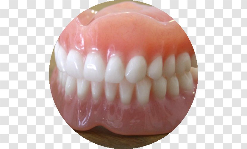 Dentures Prosthesis Dentistry Dental Implant Tooth - Removable Partial Denture - Crown Transparent PNG