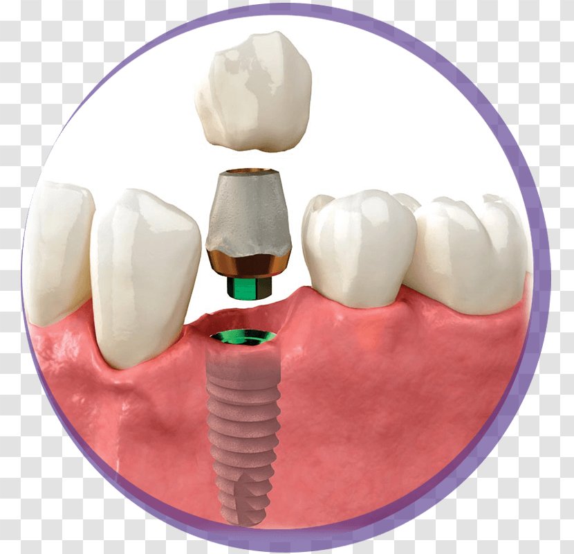 Tooth Dental Implant Crown Zimmer Biomet - Flower Transparent PNG