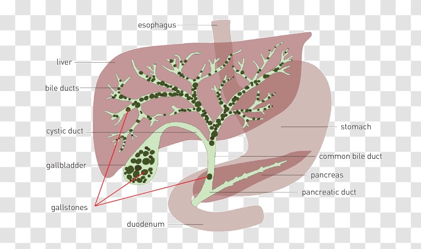 Liver And Gallbladder Gallstone Bile Flush - Cartoon - Activities Will Be Reduced At Full Time Transparent PNG