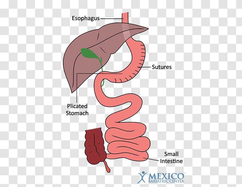 Duodenal Switch Bariatric Surgery Sleeve Gastrectomy Gastric Bypass - Cartoon - Operation Transparent PNG