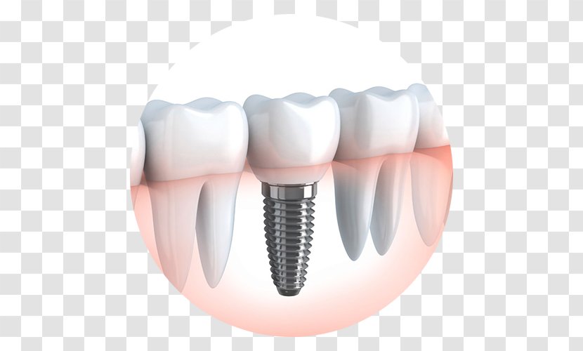 Dental Implant Cosmetic Dentistry Surgery - Flower - Sani Group Transparent PNG