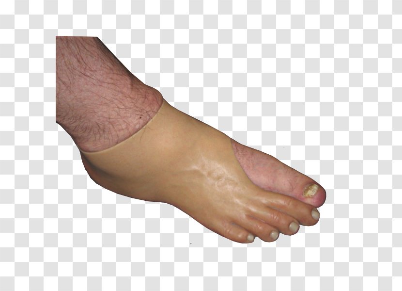 Thumb Toe Foot Amputation Prosthesis - Tree - Hand Transparent PNG