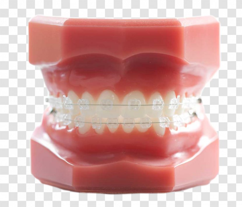 Tooth Orthodontics Dentistry Dental Braces - Model Transparent PNG