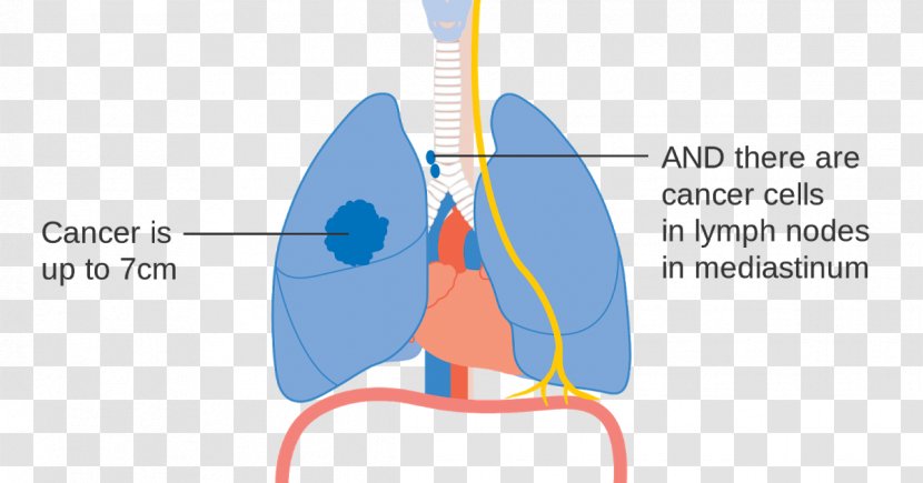 Lung Cancer Staging - Cartoon - Human Lungs Transparent PNG