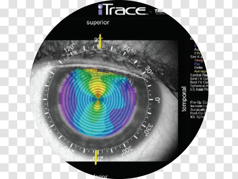 Ophthalmology Eye Examination Astigmatism Far-sightedness - Lasik Transparent PNG